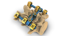 Posterior Fixation Spine Systems 